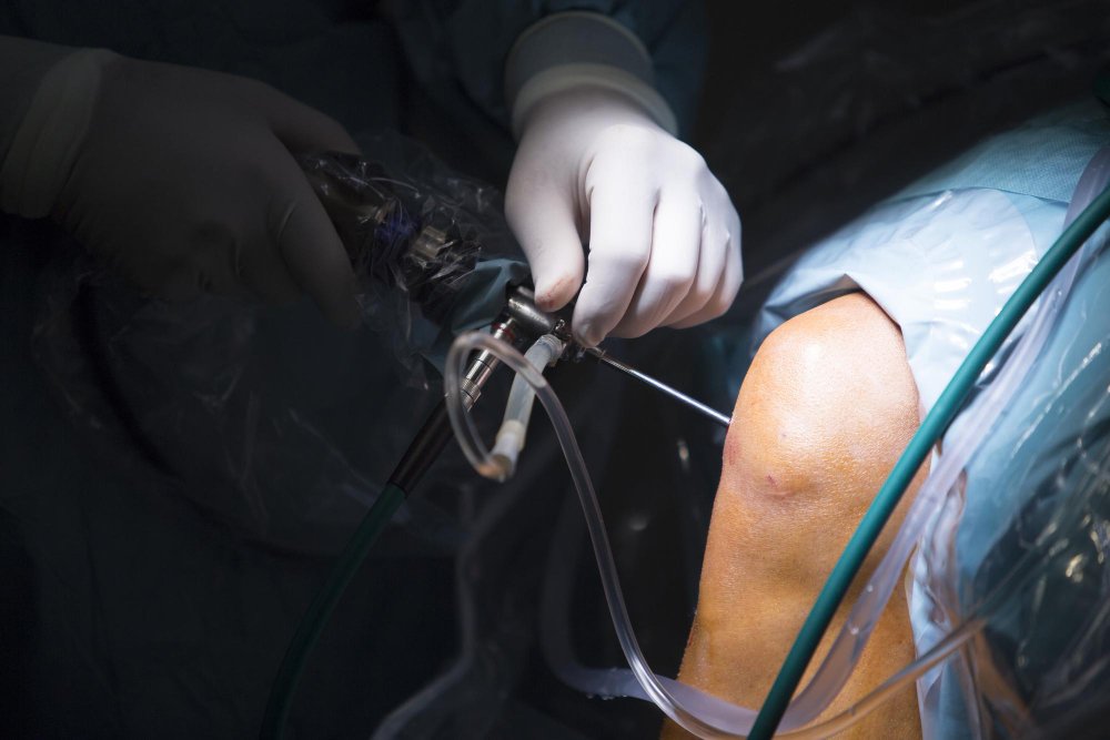 Knee Arthroscopy: Procedure, Benefits, Risks, and Recovery